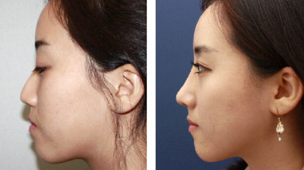 假體隆鼻加玻尿酸哪個(gè)好？