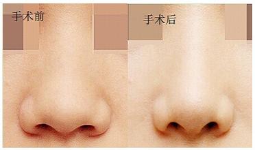 鼻孔縮小術(shù)要多少錢？