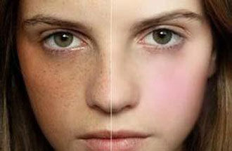 激光去雀斑多少錢？