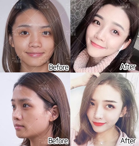 臉凹？面扁？鼻塌？沒下巴？幾支玻尿酸全搞定！