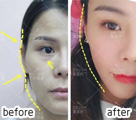 玻尿酸，讓你蛻變！