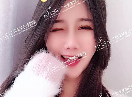 3個小姐姐真實(shí)分享，肋軟骨隆鼻感受！