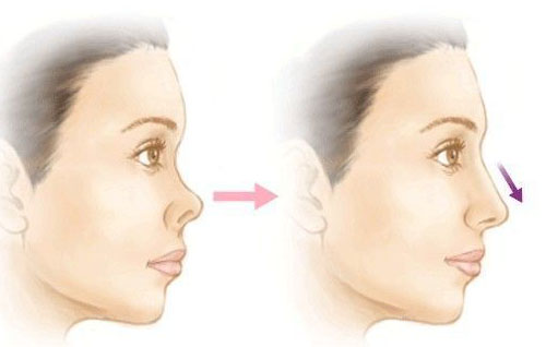 注射玻尿酸隆鼻能維持多少個(gè)月？