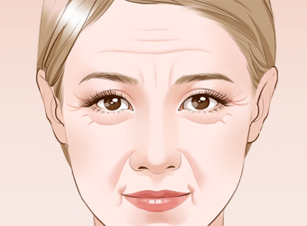 如何消除法令紋？