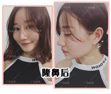 塌鼻進化史：“日拋鼻”我不爽你很久了！