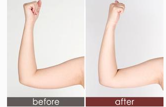 手臂吸脂的費(fèi)用多少？