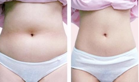 抽脂減肥需要多少錢(qián)？