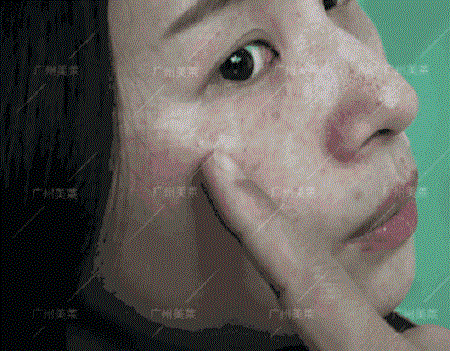 what?護膚品祛斑不成，反成熒光臉？