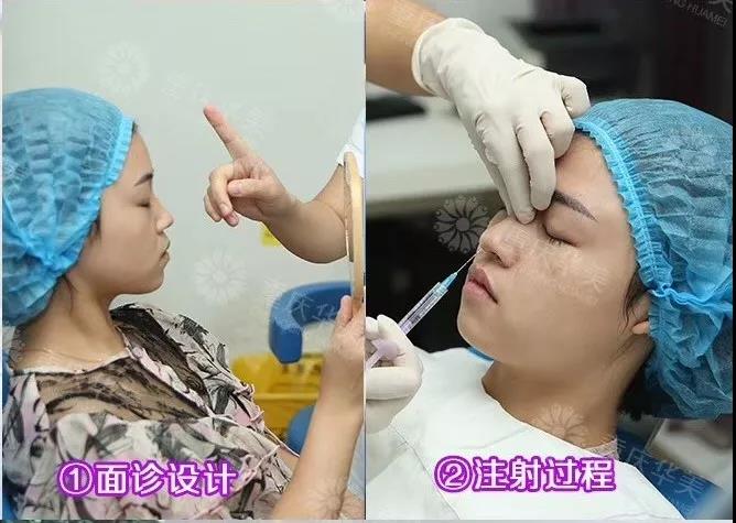 自測 | 30秒就知道你適不適合打玻尿酸！