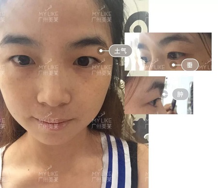 割完雙眼皮氣質(zhì)大變身?。?！