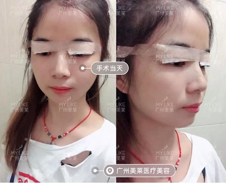 割完雙眼皮氣質(zhì)大變身?。?！