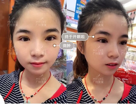割完雙眼皮氣質(zhì)大變身?。?！