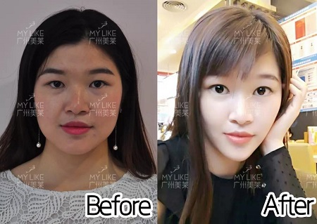 玻尿酸瘦臉通通￥399！吃土女孩必buy！