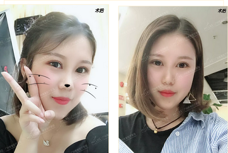 割雙眼皮后，像戴美瞳一樣有神！