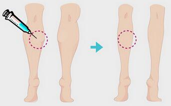 一針瘦腿多少錢？