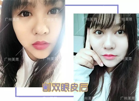 懵豬小眼割雙眼皮后，睜眼美到跪！