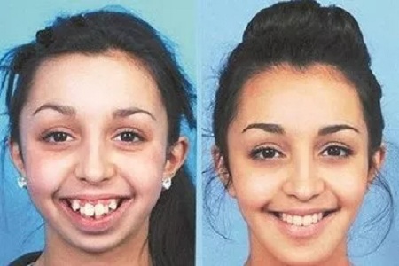 牙齒矯正術(shù)前術(shù)后