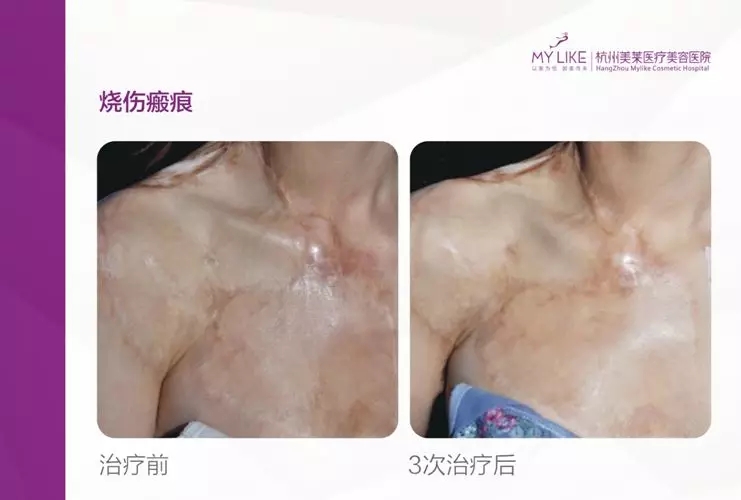 免費皮膚疤痕修復(fù)