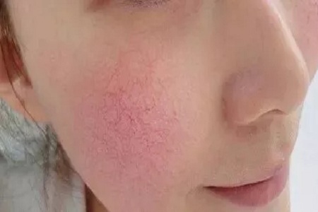 經(jīng)?！凹t臉蛋”是病，得治！