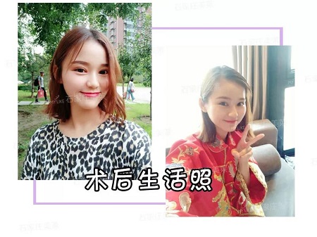 我近視做雙眼皮，對眼睛有影響嗎？圍觀小姐姐術后反饋！