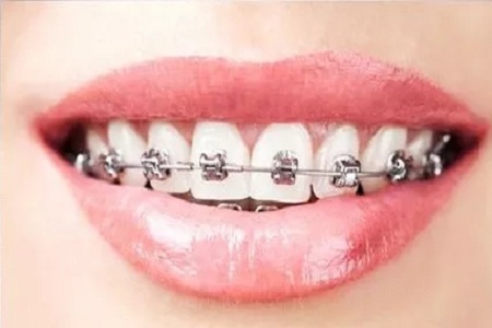 震驚！牙齒矯正效果堪比整容！這是真的嗎？
