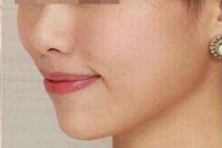 自體脂肪豐蘋(píng)果肌