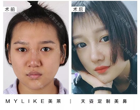 鼻子有這2個(gè)bug