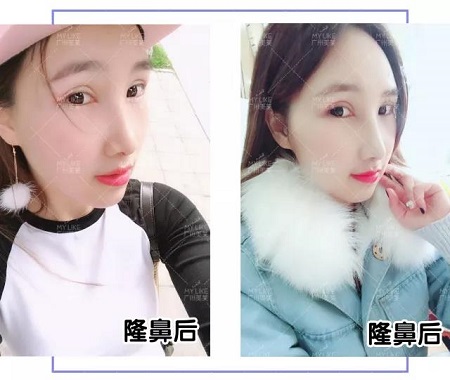 隆鼻7天后，塌鼻妹紙變焦點(diǎn)女神？