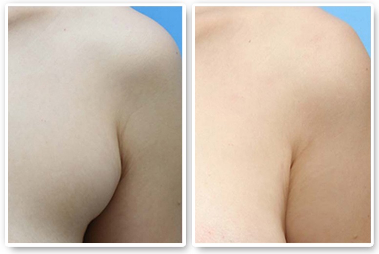 副乳切除手術(shù)是持久的嗎？