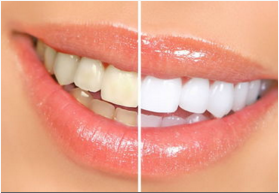 冷光美白牙齒多少錢？