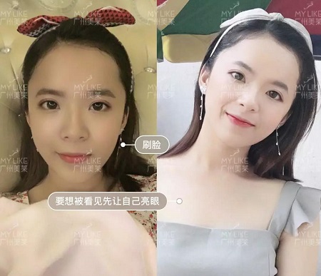 22歲畢業(yè)禮，竟被爸媽拉去割雙眼皮？！