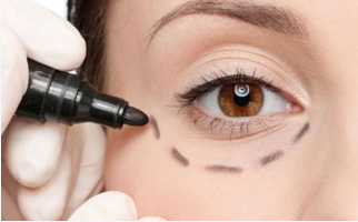 去眼袋內(nèi)切需要多久恢復(fù)？