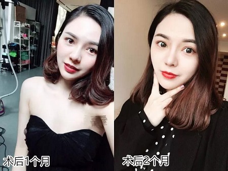 她只是做了鼻子整形，立馬變上鏡殺手！