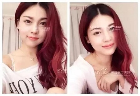 為什么打了玻尿酸，還要我再打玻尿酸？