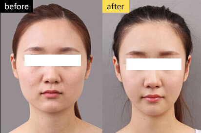 瘦臉多少錢一針？