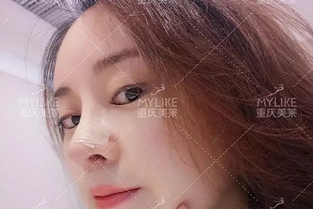 “鼻綜合”后假又歪，還攣縮？鼻修復還原自然生態(tài)美鼻