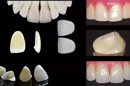 給牙齒“改頭換面”， 讓牙齒看起來又白又美~