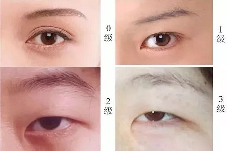 推薦這幾種增大眼睛的方法，除了開外眼角！