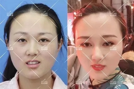 推薦這幾種增大眼睛的方法，除了開外眼角！