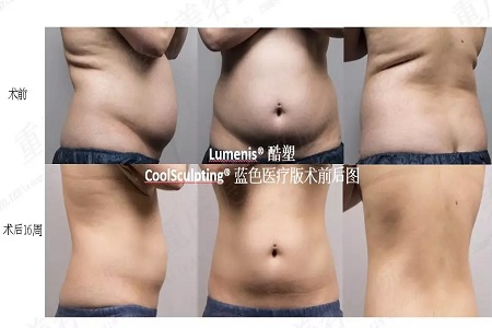 瘦身Flag挑戰(zhàn)賽 | “躺著就能瘦”真的不是夢(mèng)，人人都可以！