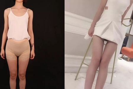 吸脂，怎樣做才算是剛剛好？