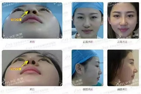 隆鼻手術(shù)切口在哪里？才能自然不留疤