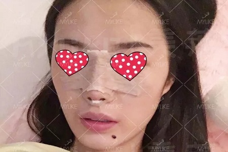 顏值：隆了個(gè)鼻子，男朋友說(shuō)像換了一個(gè)女朋友