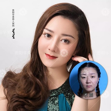 沒有騙你！雙眼皮手術(shù)輕松就能夠解決七大問題