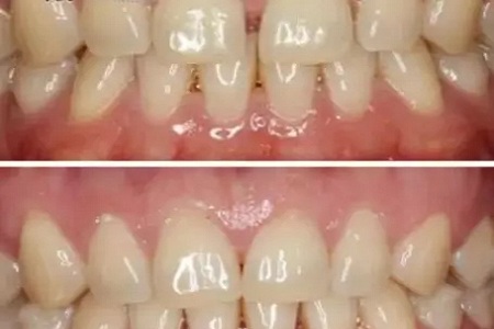 矯正 PK 牙貼面！關(guān)閉牙縫應(yīng)該pick哪一個(gè)？