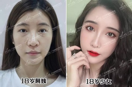 填脂肪21天，老媽竟阻止我相親！why？