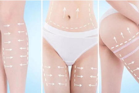 Bodytite黃金微雕：比吸脂更好的瘦身利器