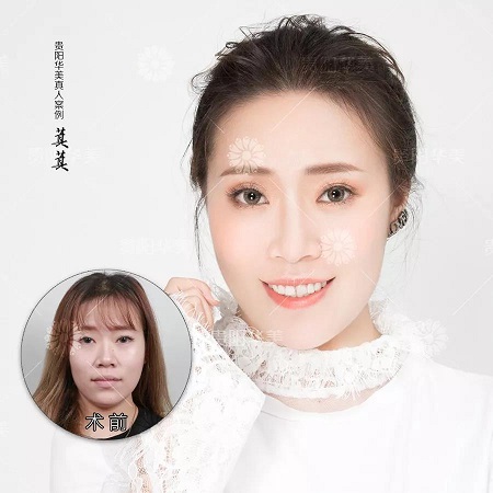 兩針玻尿酸擁有側(cè)顏殺，90%的仙女都缺它！