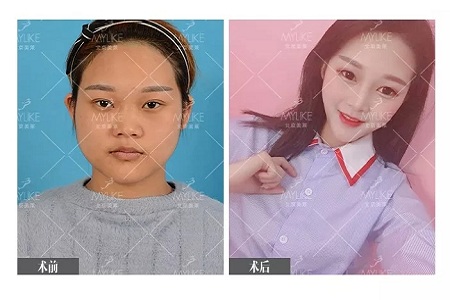 顏值：鼻子的改變能讓一個女孩變化有多大？