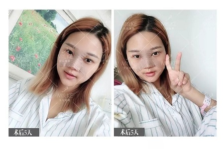 顏值：鼻子的改變能讓一個女孩變化有多大？